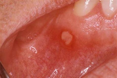 A red bump or sore may develop if the skin is scratched or pricked. . Vulvar aphthous ulcers pictures